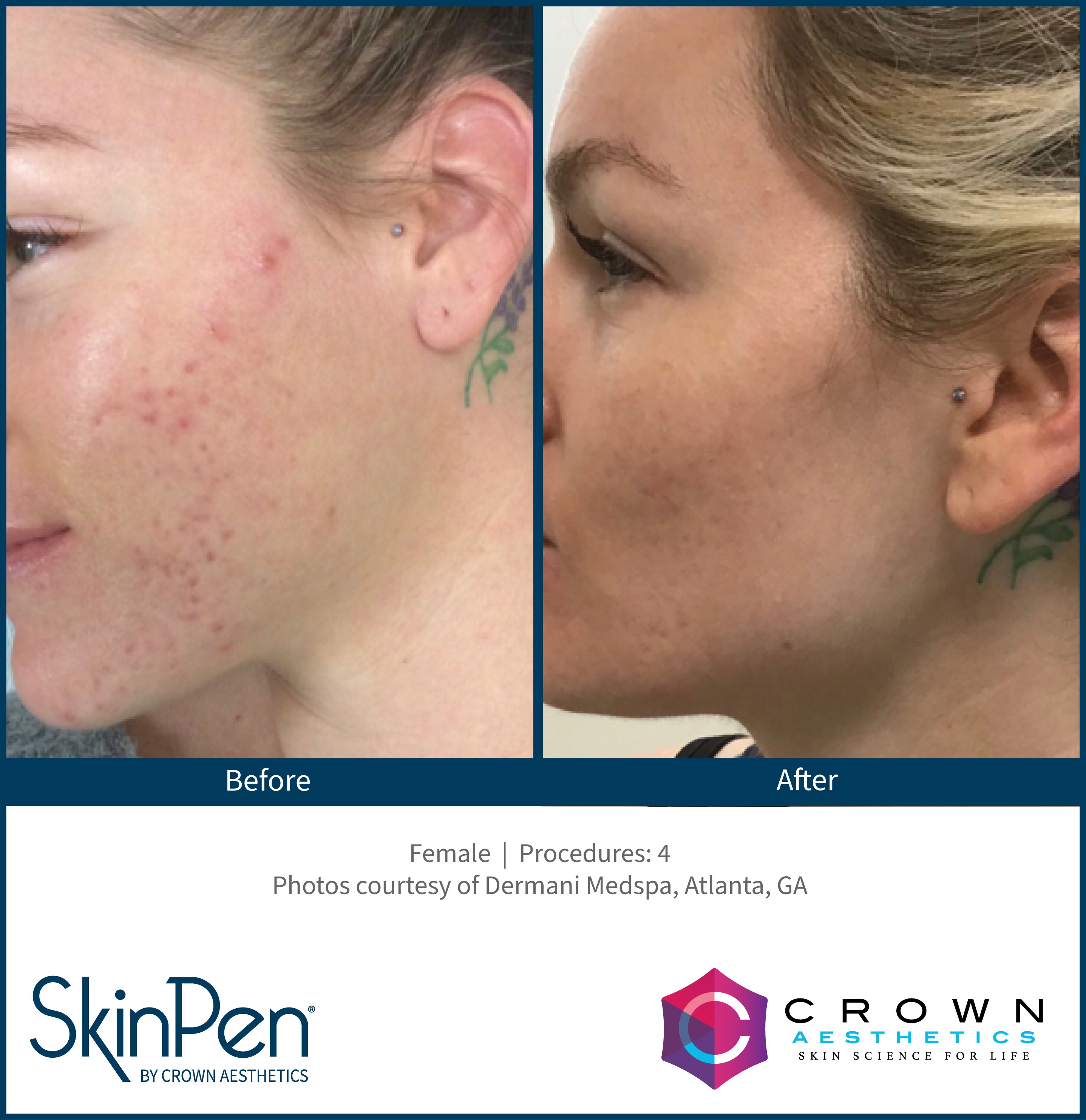 SkinPen acne scar before and after